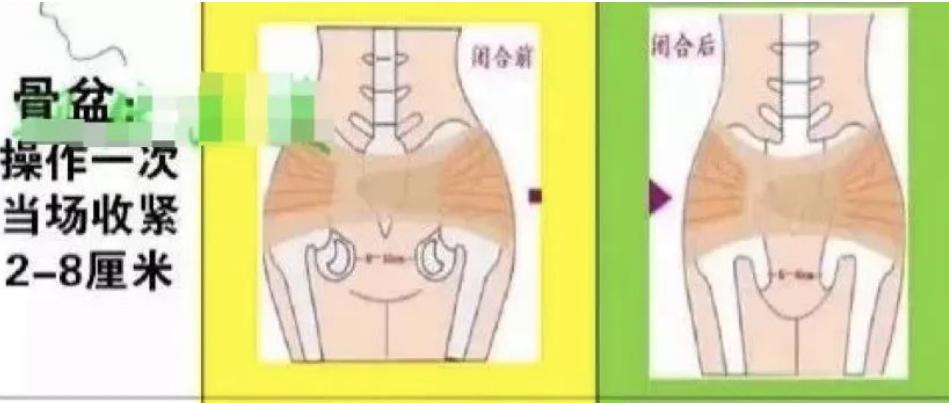最全产后骨盆修复,流行产后骨盆修复
