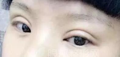 同样做双眼皮为什么价格差那么多,眼袋和双眼皮同时做眼会变小吗