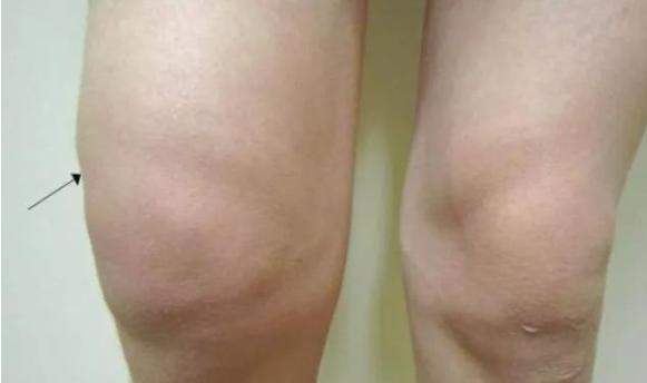 膝关节肿都不能回弯了怎么回事,膝关节肿胀并且不能弯曲和伸直