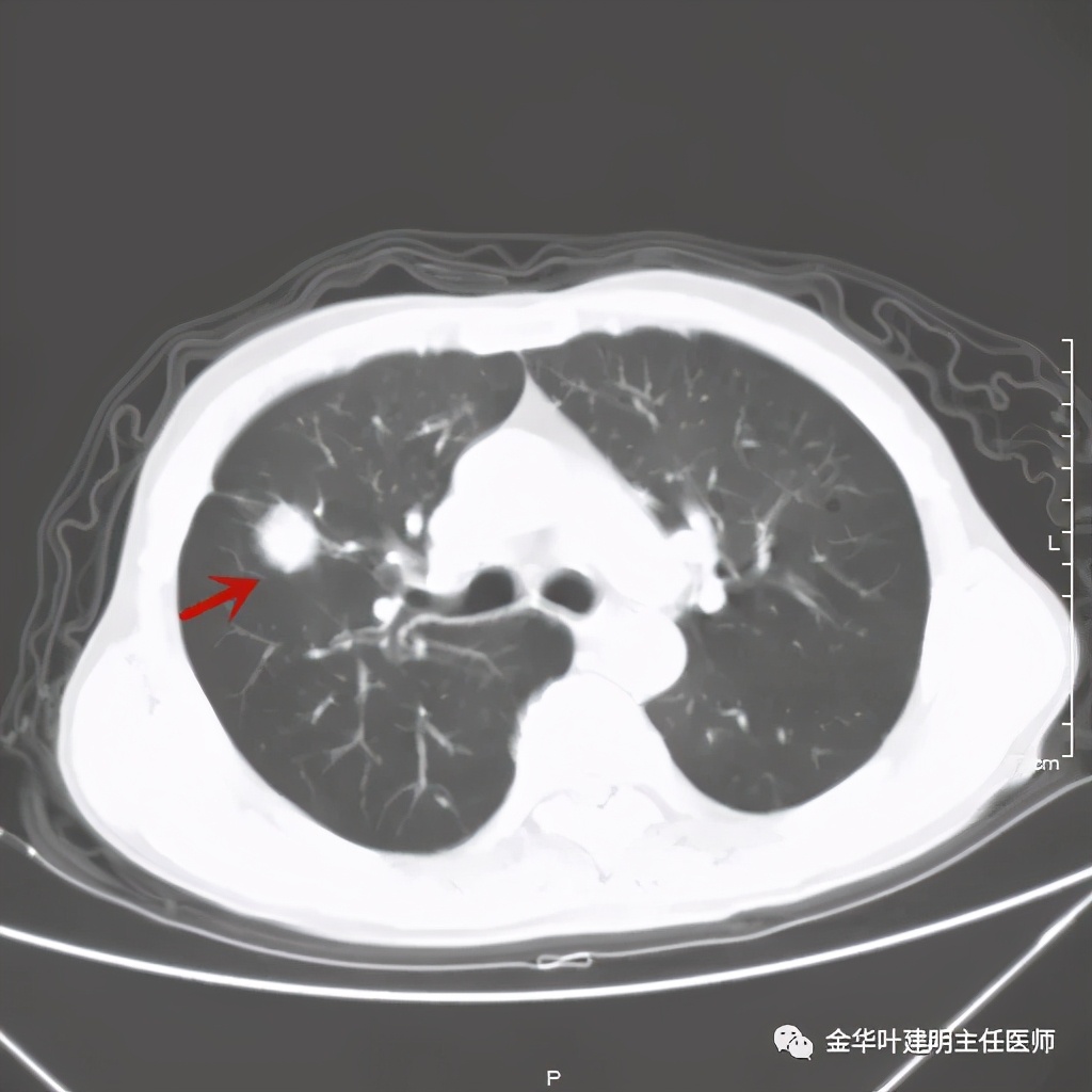 左肺占位被安排穿刺活检是肺癌吗,肺癌肺部穿刺有什么危险