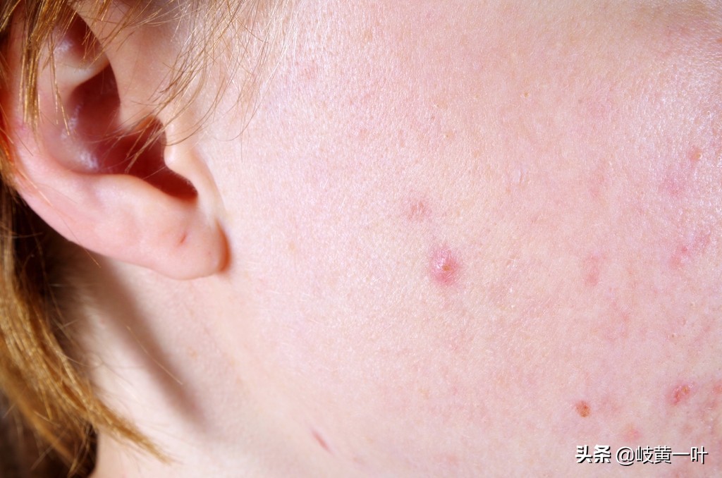 长青春痘的原因及调理方法,青春痘肌肤的首要问题如何解决