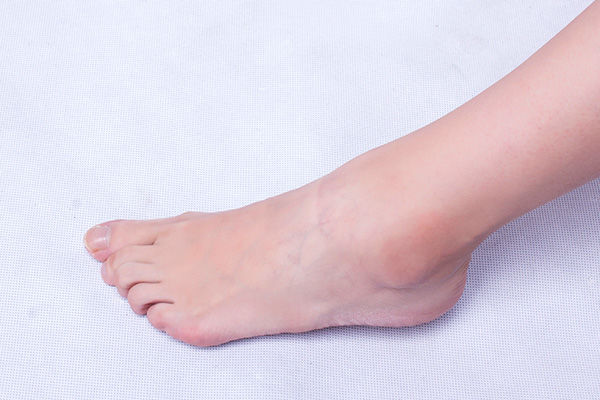 走路脚后跟痛是痛风的原因吗,尿酸高脚后跟走路酸痛是痛风吗