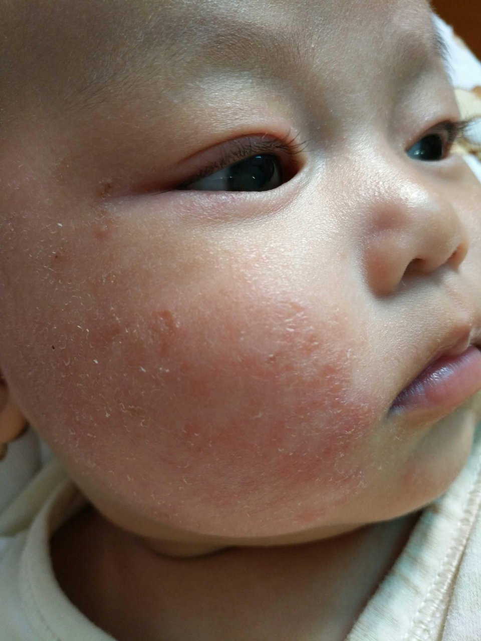 宝宝湿疹妈妈需要干预吗,宝宝湿疹反复怎么从根本解决