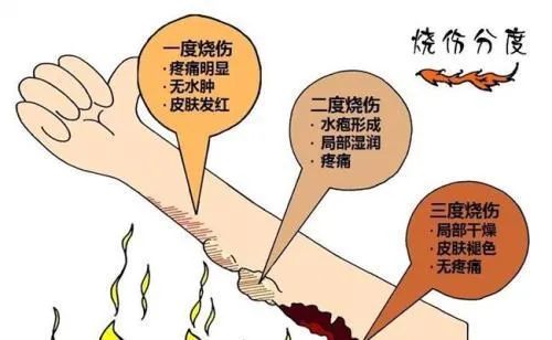 穿着衣服被开水烫伤急救,开水烫伤急救方法