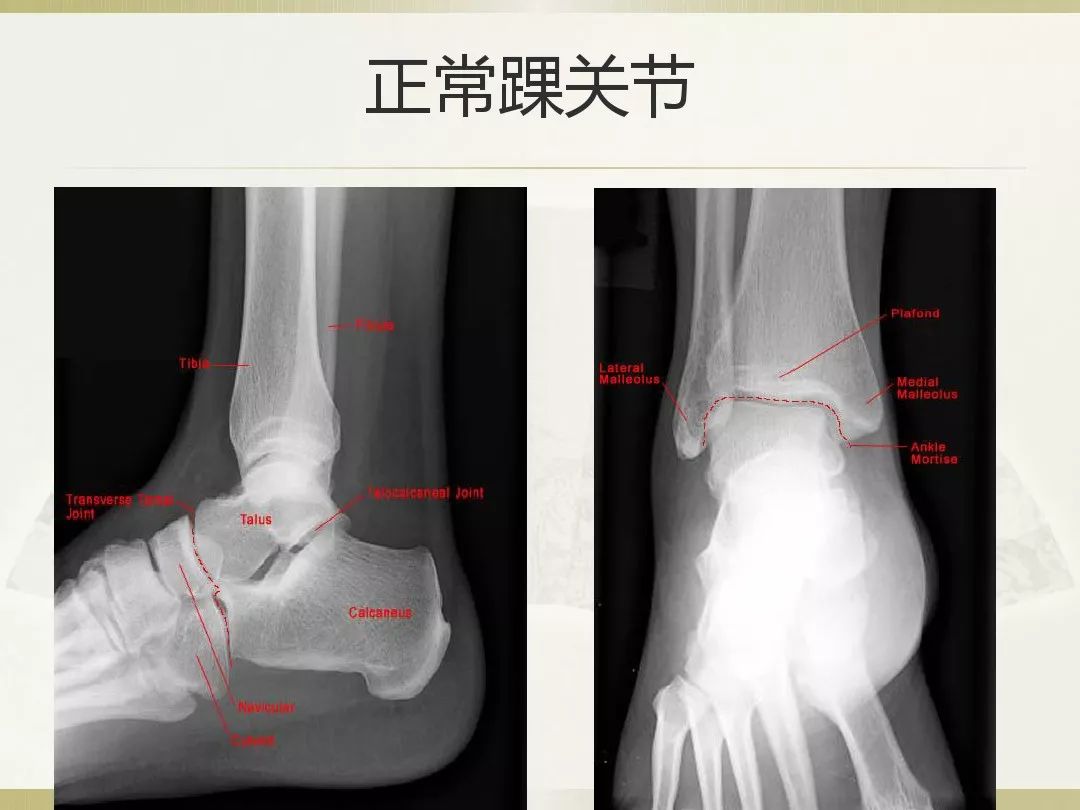 骨科x光片读片技巧,放射科骨科读片教程