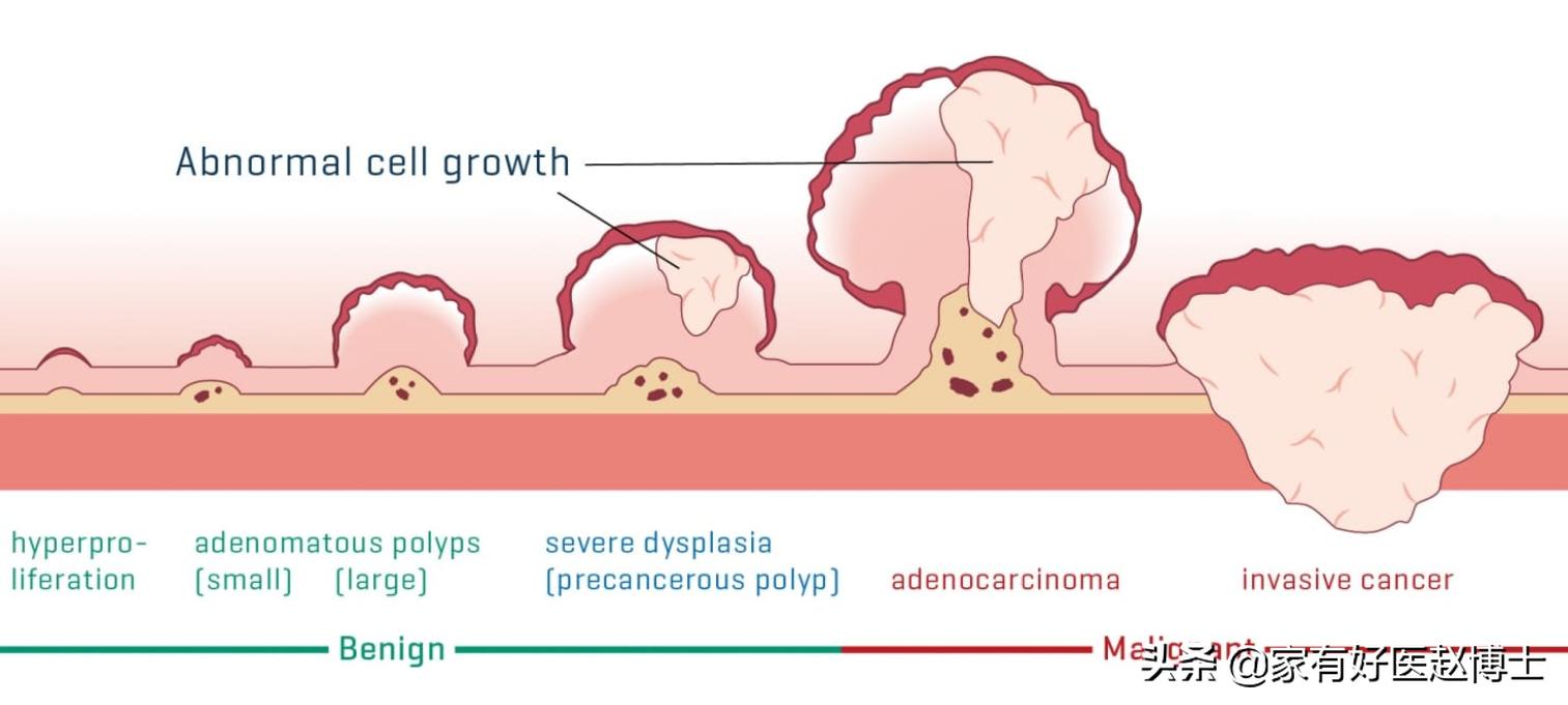 最常见5类息肉每个人都可能有，哪些无癌变风险，哪些需要切除？