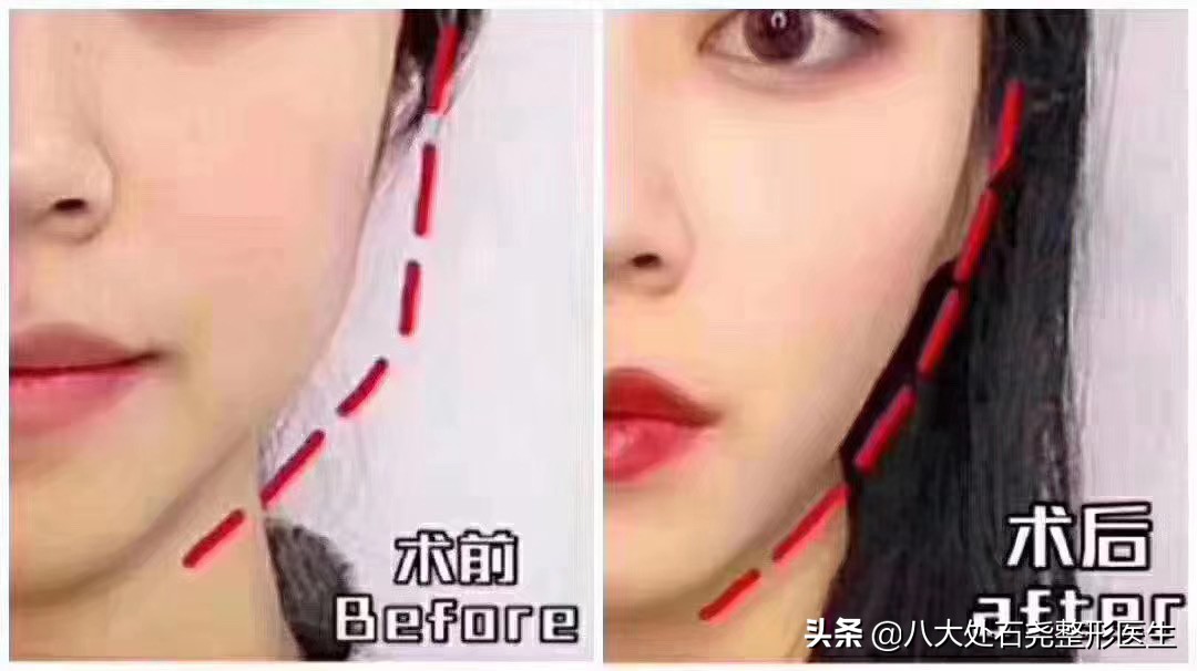 瘦脸针后苹果肌下垂凹陷能恢复吗,你有脸部下垂的烦恼吗