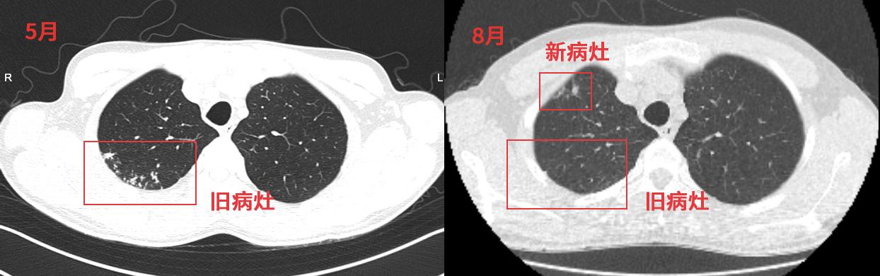 结核治好了后还是忽冷忽热,结核治疗期间病灶变大正常吗