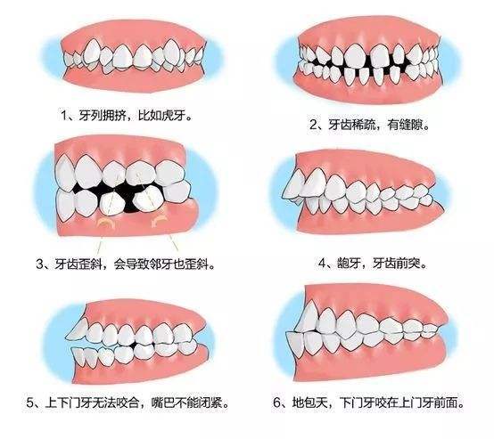 戴牙套不一定变好看,拔牙后戴牙套难看怎么办