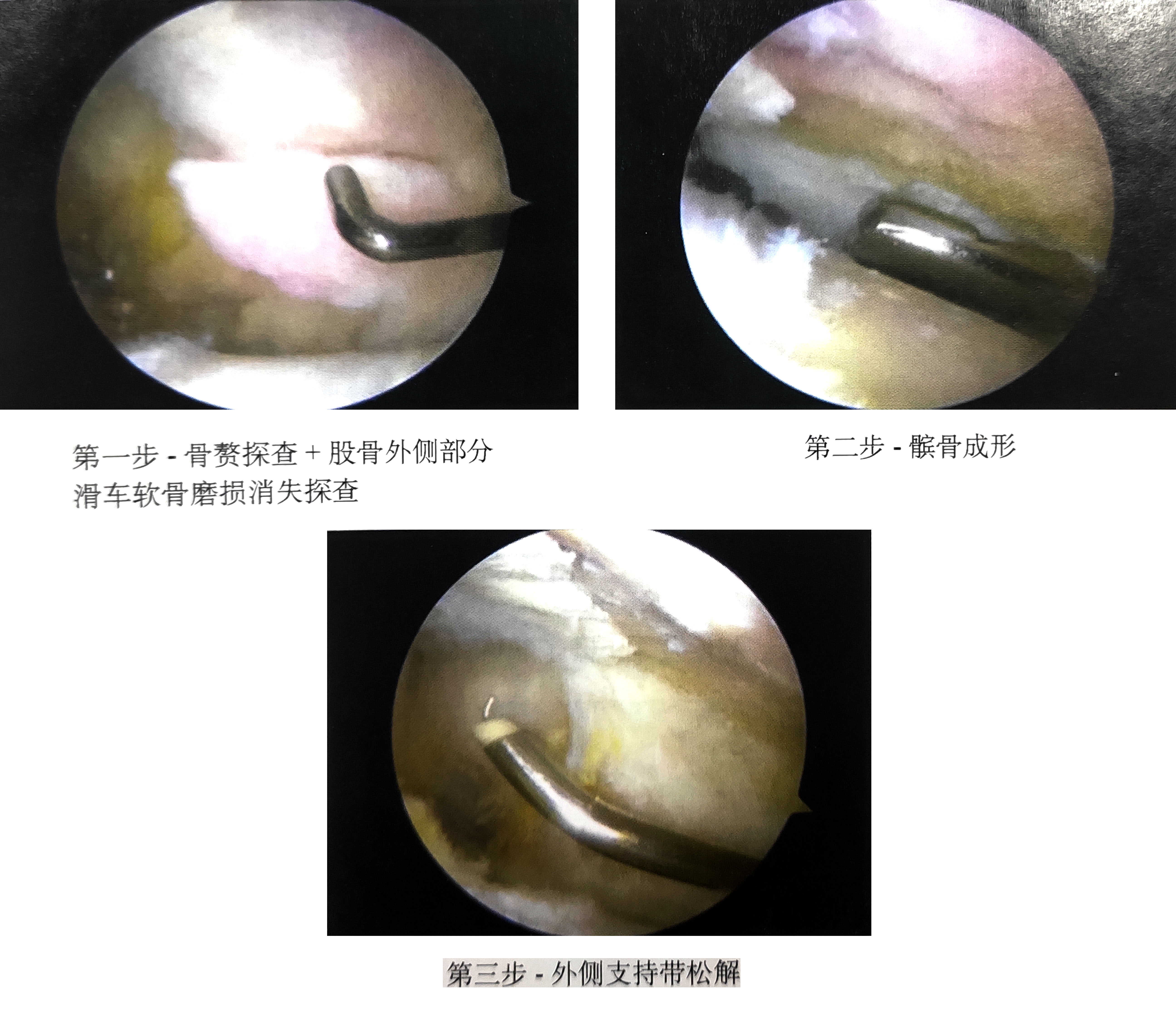 髌骨软化症的病因诊断和治疗探索,正确认识膝关节