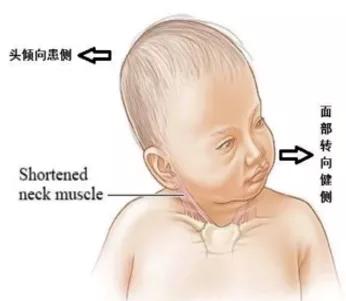 写字防歪头姿势纠正神器,儿童歪头最好的纠正法