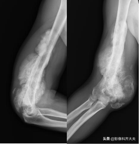 骨折的影像学检查及各自的优势,骨折的影像学愈合标准