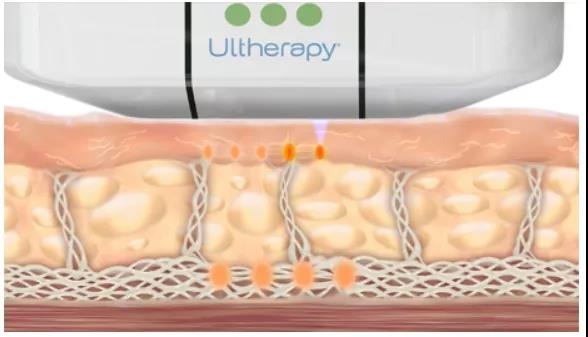 抗衰超声刀的原理和功效,超声刀超百万案例证实的抗衰效果
