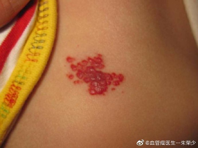 患了海绵状血管瘤，日常中需要注意什么呢？