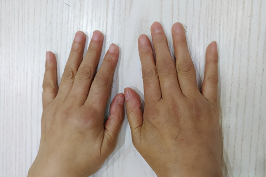 按时吃药，类风湿还是加重了，都是贫血惹的祸