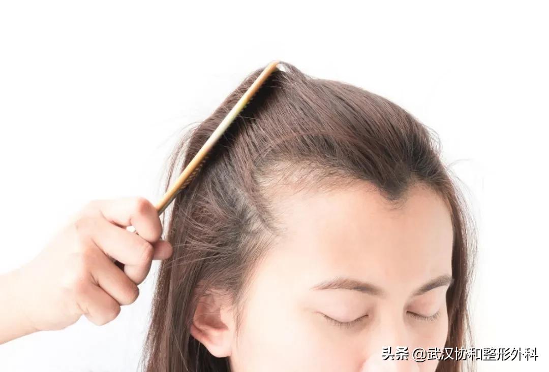 植发的十大潜规则,植发快问快答