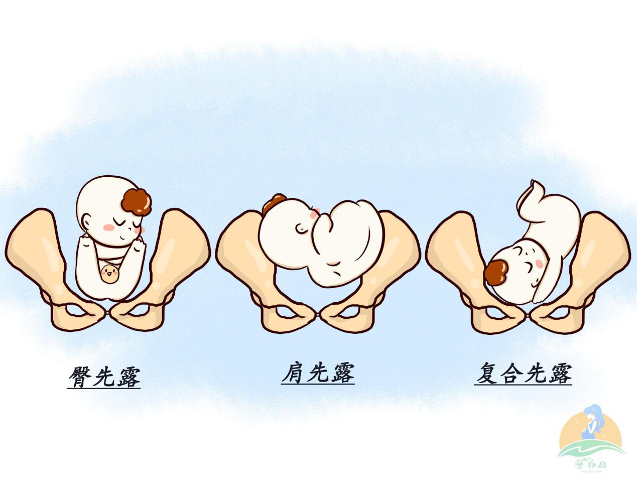 孕妈怎么知道胎位不正,临产胎位不正怎么纠正最快