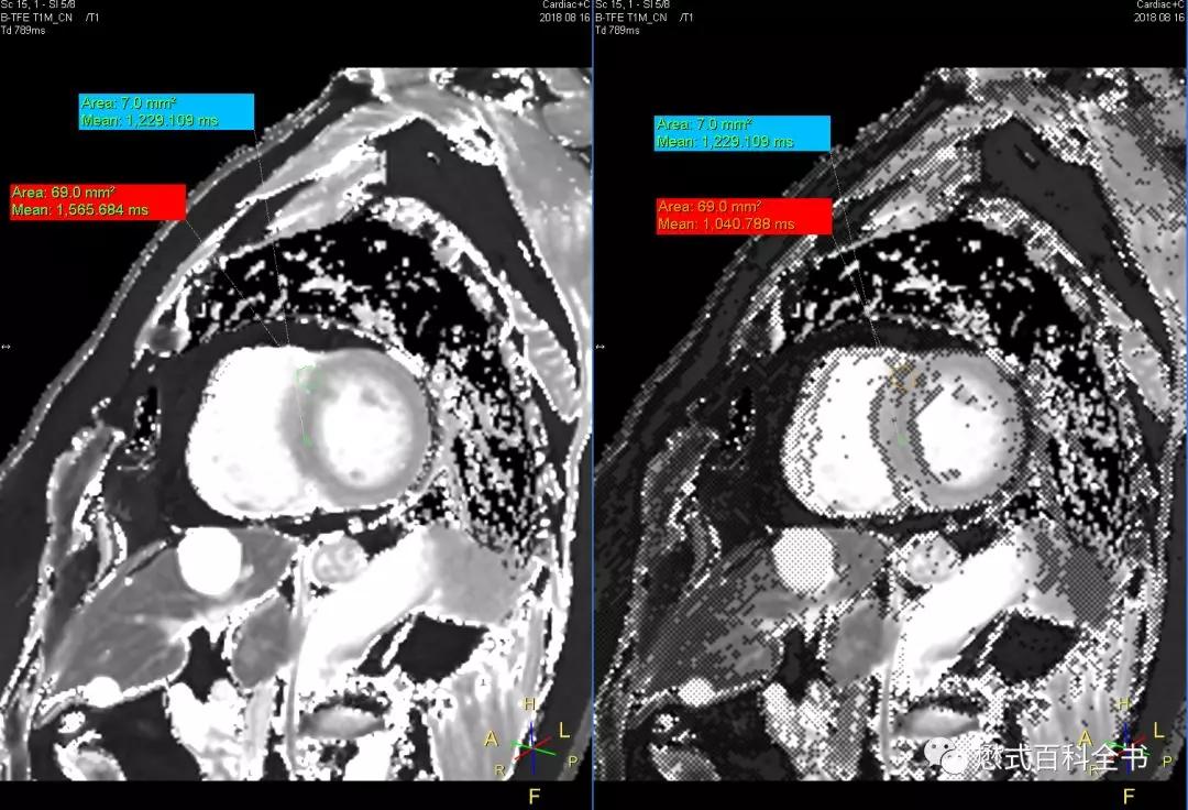 心脏磁共振定位方法,心脏磁共振各参数分析