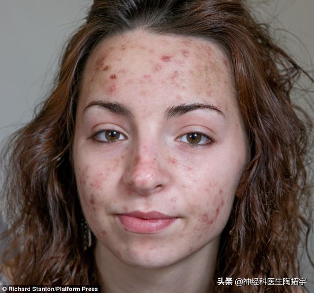 皮肤搔抓后皮疹变硬,皮肤划痕症有哪些症状