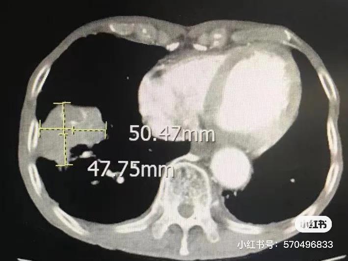冷冻针治肿瘤能活多久,一根细针可以消除肿瘤