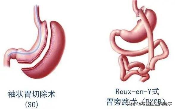 减重代谢手术后需注意事项,减重代谢手术第二周应该吃什么