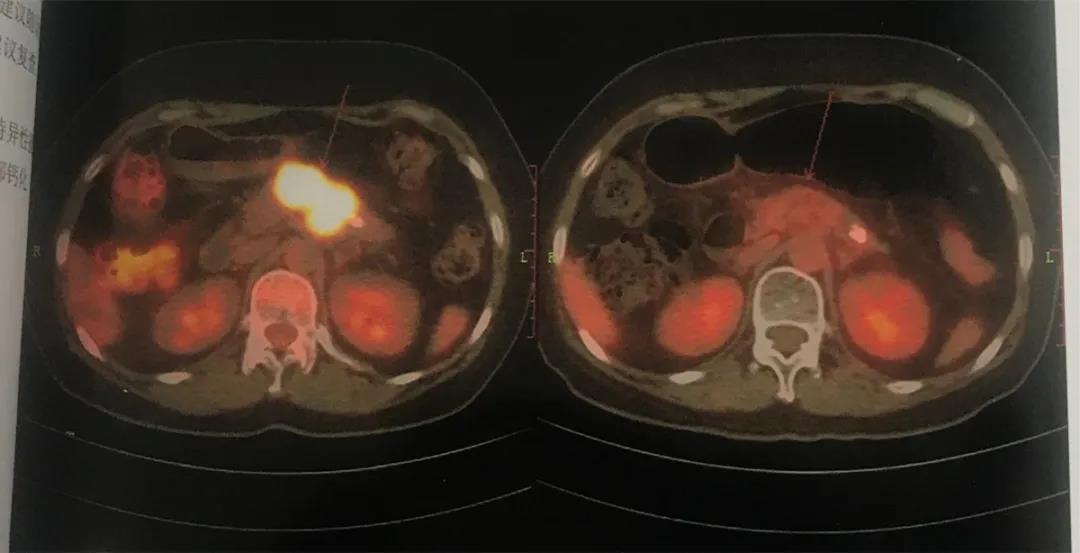癌症临终期靶向药,癌症晚期起死回生