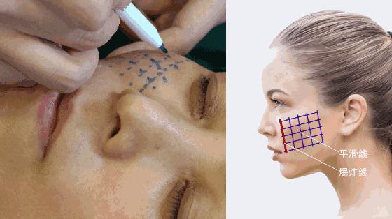 去眼纹打肉毒素吗,去眼纹打多少肉毒素合适