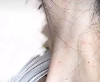 脸上莫名冒出白色小疙瘩,脸上出现奇怪的印子