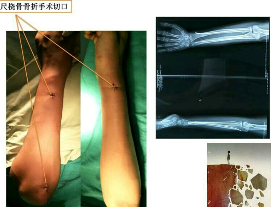 邱医生手术,邱医生祛疤