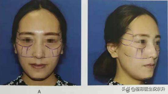 脸太瘦有什么方法能变胖吗,脸太瘦怎么办变圆增肥