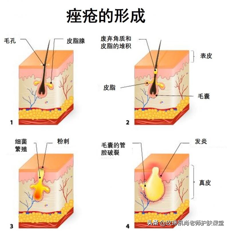额头脸颊下巴长痘怎么调理,额头脸颊下巴反复长痘如何调理