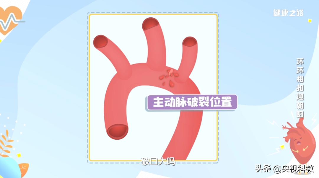 血管主动脉夹层能活多久,警惕凶险的主动脉夹层你了解多少