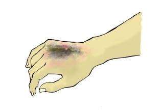 如果被烧伤烫伤最有效的应急办法,烧伤烫伤时应采取哪些措施