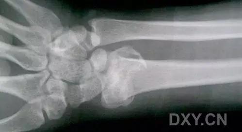 所有骨折都叫什么名字,骨折的名称有哪些