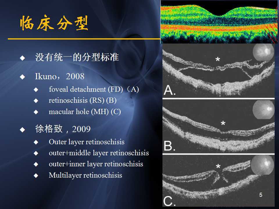 高度近视黄斑劈裂哪家医院好,高度近视黄斑劈裂中医治疗