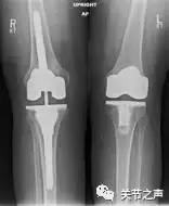 膝关节骨关节炎的阶梯型治疗方案,膝骨关节炎阶梯式治疗