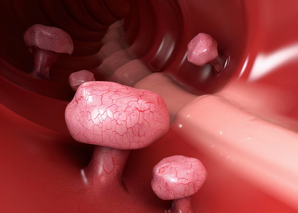 胃里长息肉切了就好了吗,为啥一年胃就长十个息肉