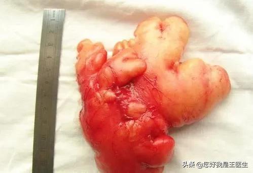 脂肪瘤如何消除？如何做到预防？