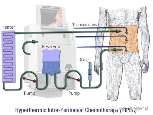 化疗药物直接注入肿瘤里面,化疗对肿瘤是杀死还是抑制
