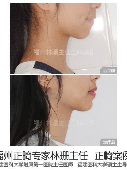 福州牙齿矫正林珊主任｜浅谈下颌后缩