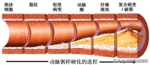 冠心病的六种常用药如何正确服用,关于冠心病中药处方