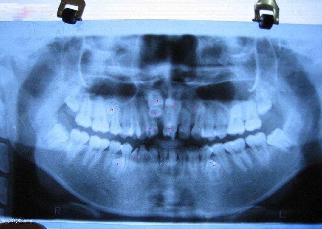 宝宝长了牙齿怎么治疗,小孩牙齿长出双牙要怎么矫正
