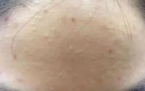 闭口烂脸的解决方法,脸部闭口怎么彻底解决