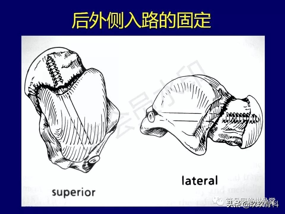 距骨骨折的治疗原则,距骨骨折如何调理