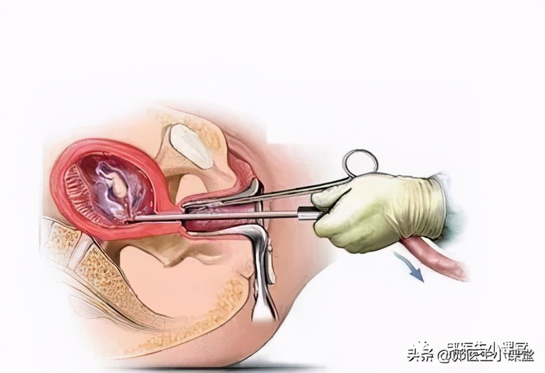 医生会告诉你流产后会不孕吗,医生说以后怀孕的几率很低