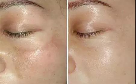 常见皮肤色斑有哪些怎么鉴别,面部色斑的鉴别诊断视频