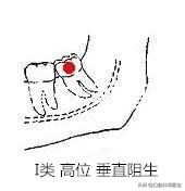 智齿分轻重嘛,智齿水平和非水平的区别