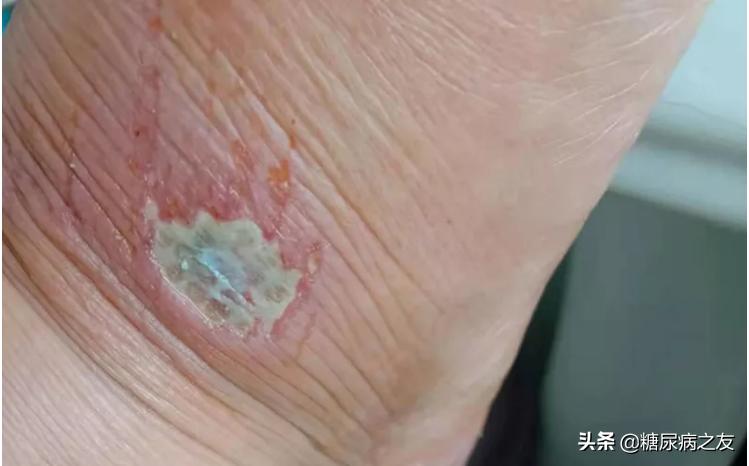 糖尿病足部神经病变有伤口能好吗,糖尿病足创面处理要点