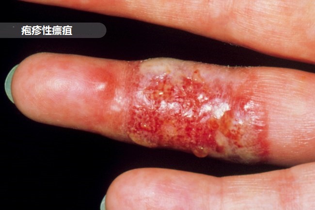 手指头肿了需要去医院吗,单个手指头肿胀要警惕四种病