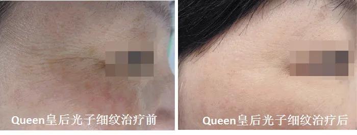 护肤光子嫩肤,光子嫩肤和脱毛操作